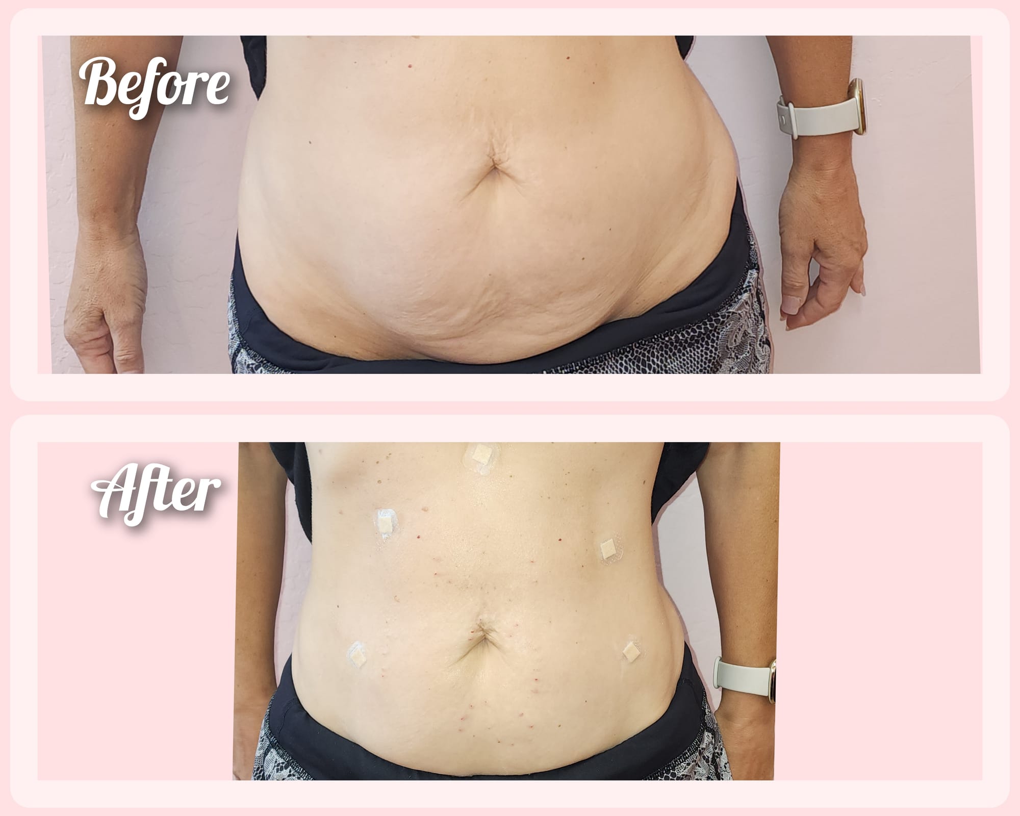 Pdo Smooth and screw threads