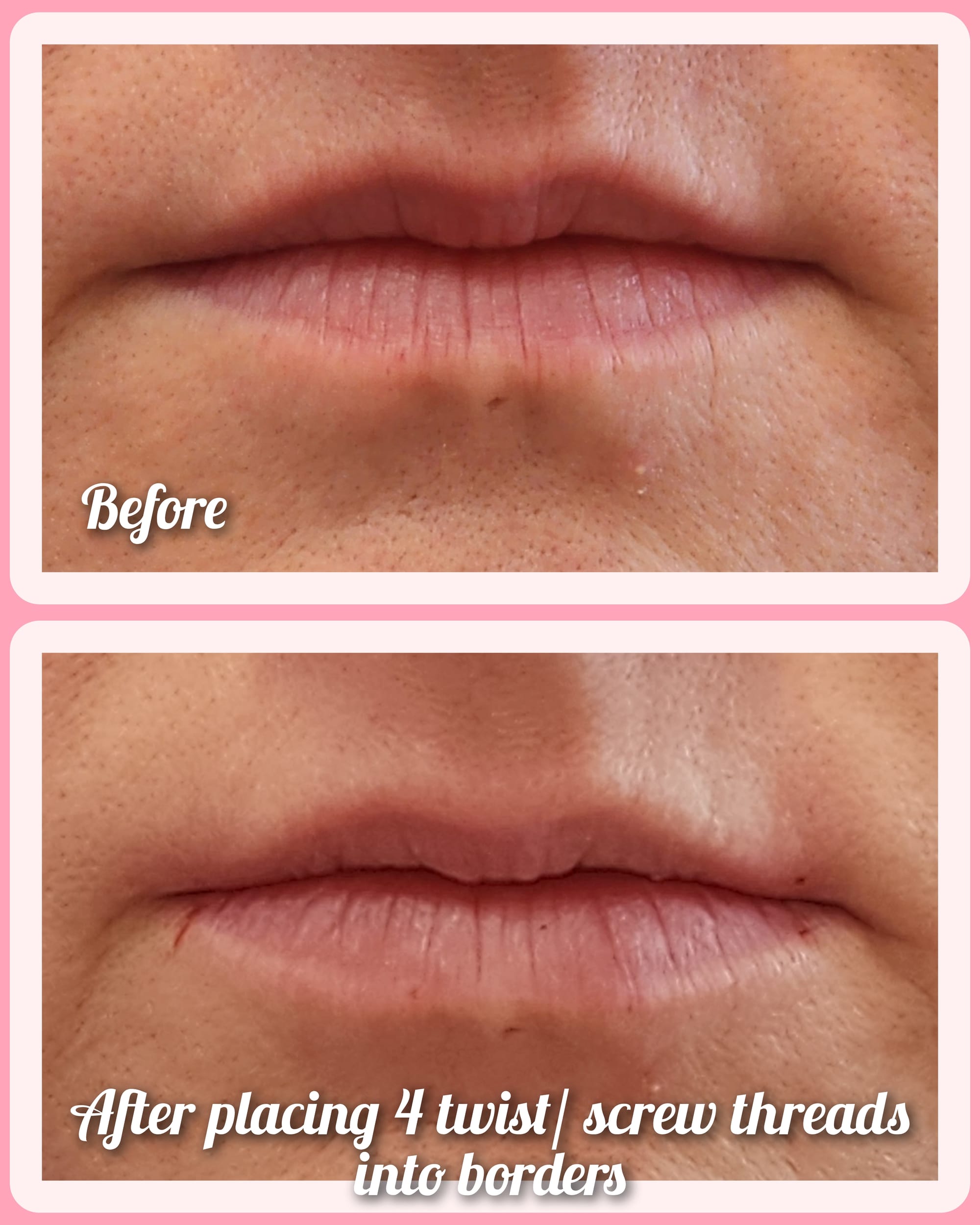 Pdo Smooth and screw threads