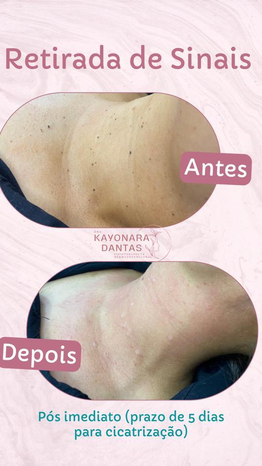 CONHEÇA MAIS SOBRE O PODER DO JATO DE PLASMA