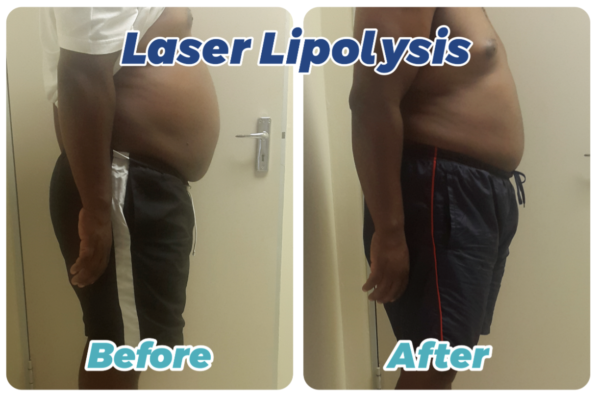 Laser Lipolysis  2 in 1 Exclusive 