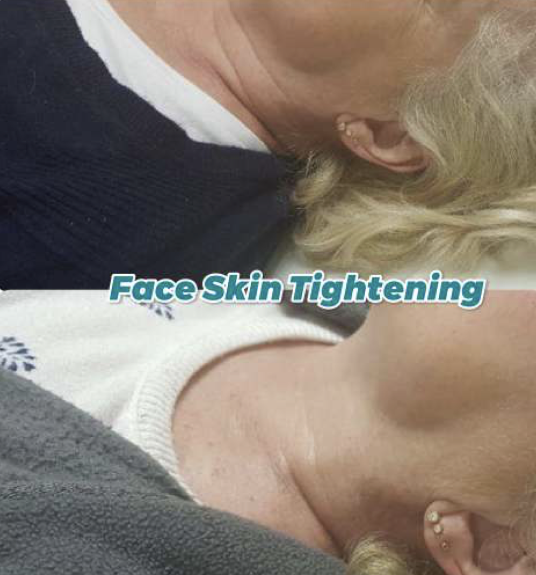 Skin  Tightening 