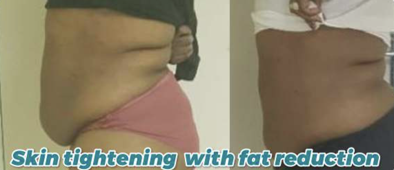 Skin Tightening 