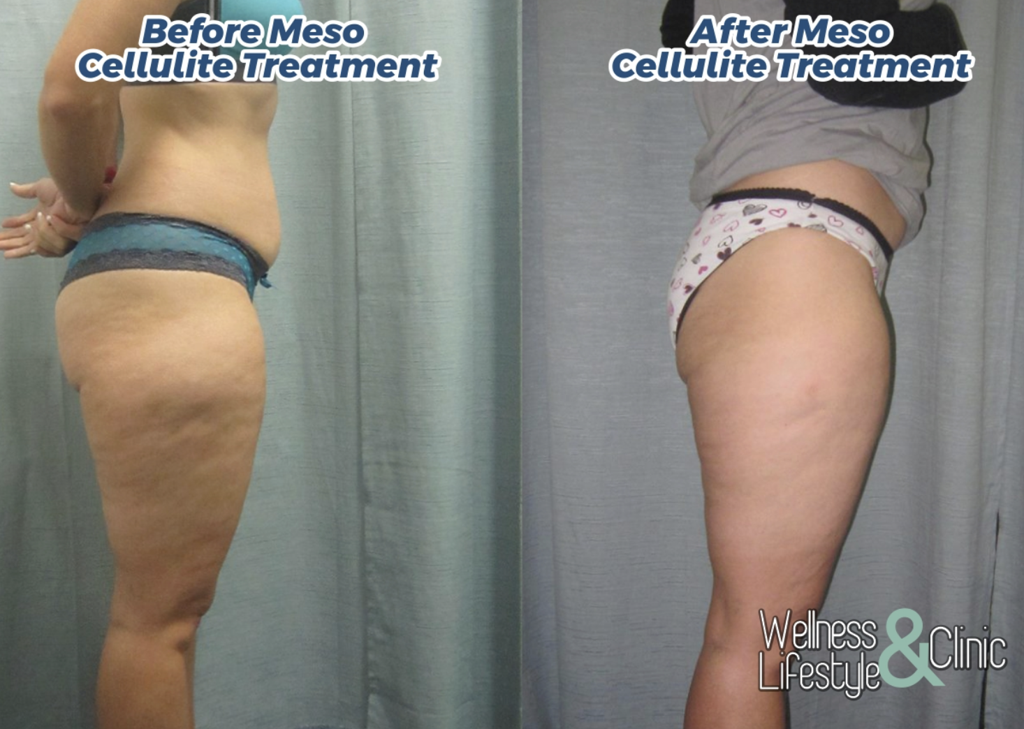 Meso Cellulite 