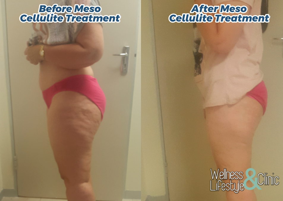 Meso Cellulite 