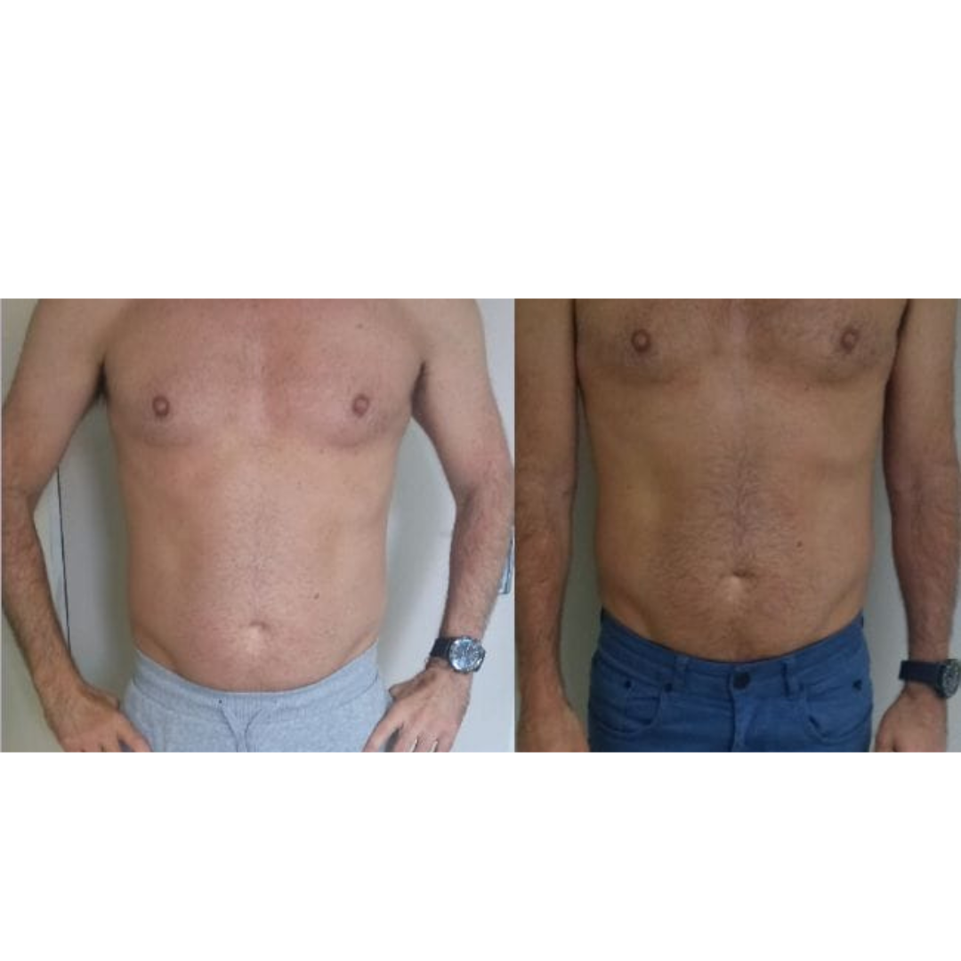 Men Tummy Reduction 
