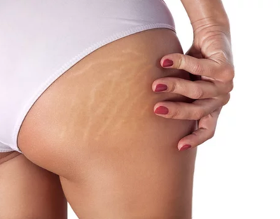 STRETCH MARKS