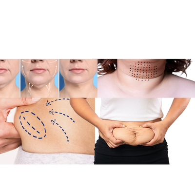 NON INVASIVE LIPODISSOLVE