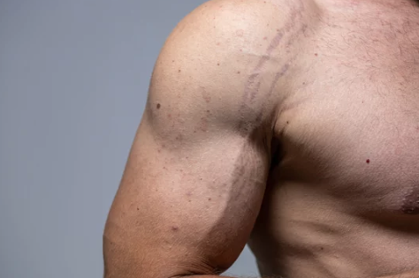 Stretch Marks