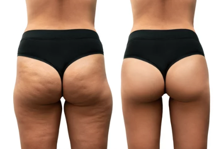 CELLULITE REDUCTION