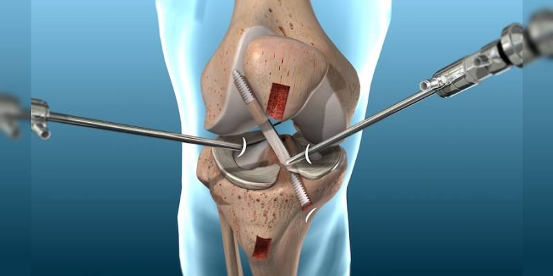 Knee Arthroscopy Surgery: