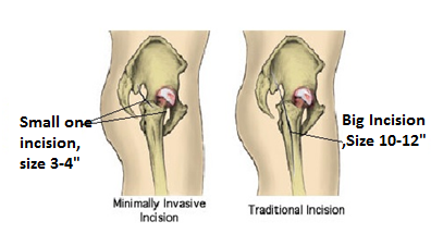 Hip Replacement Surgery