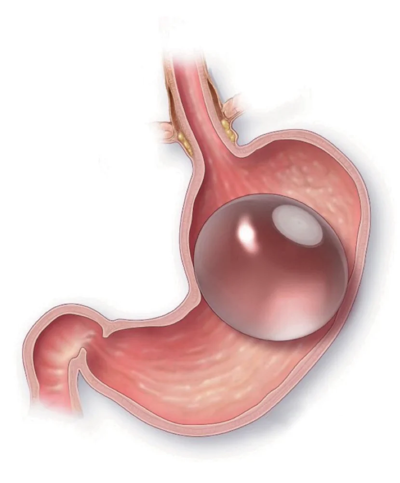 بالون المعدة الحديثه