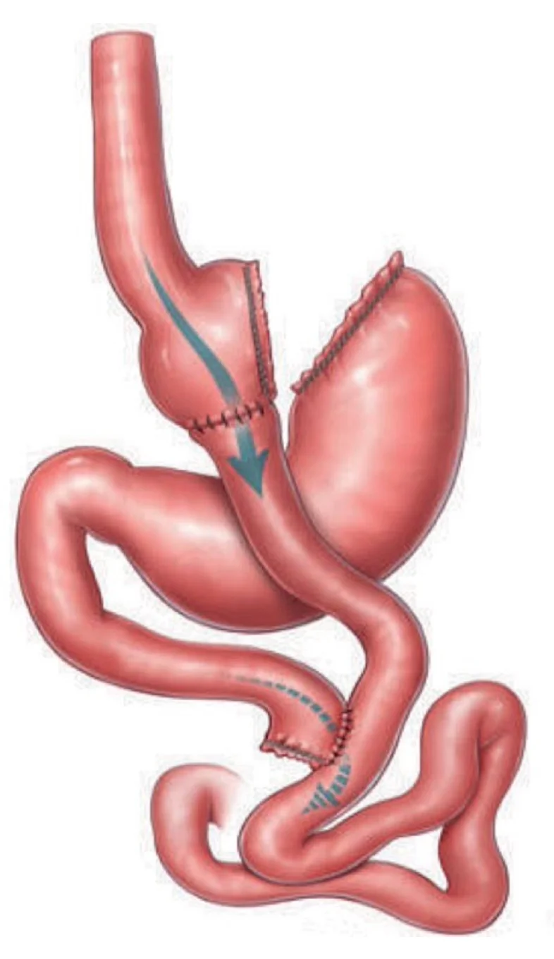 عملية تحويل المسار الكلاسيكي