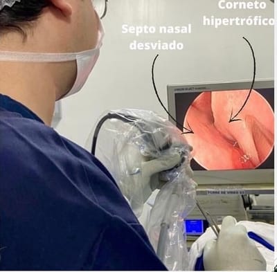 DESVIO DE SEPTO NASAL
