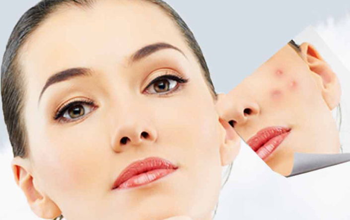 How to Get the Most Out of Acne Scars Treatment in Dubai