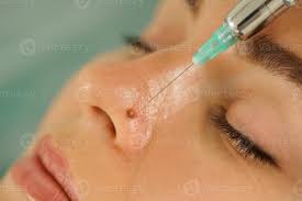 "Reveal Your True Beauty: Discover the Magic of Mole Removal Treatments"