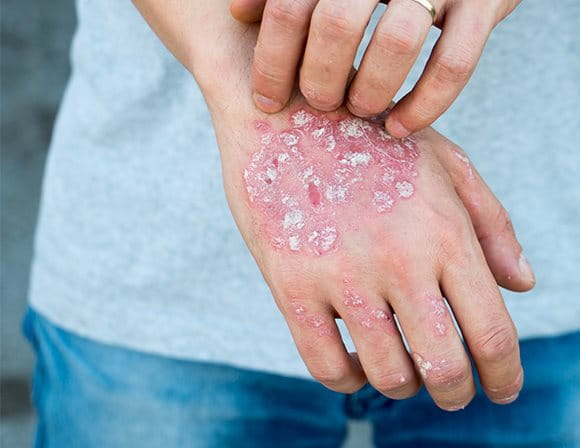 Psoriasi e dermatite atopica