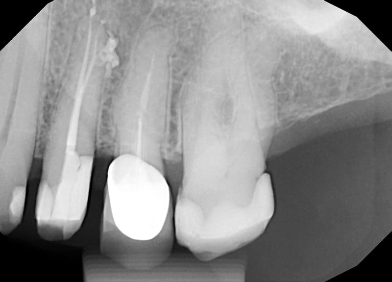 Leczenie powtórne d.14