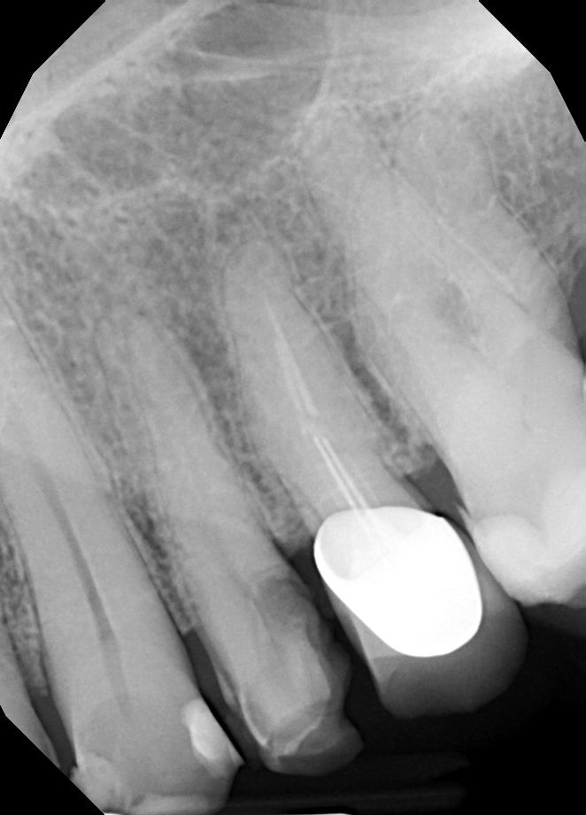 Leczenie powtórne d.24