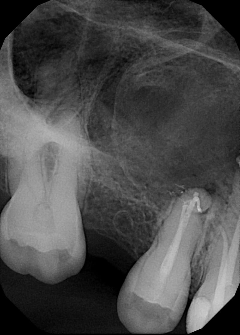 Leczenie pierwotne d.15
