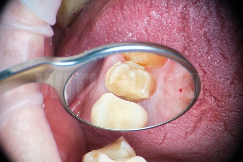 Leczenie powtórne d.24