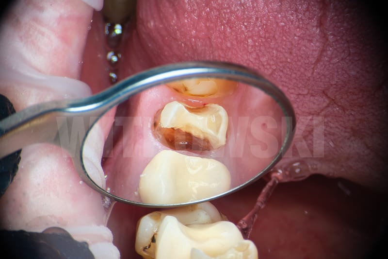 Leczenie powtórne d.24