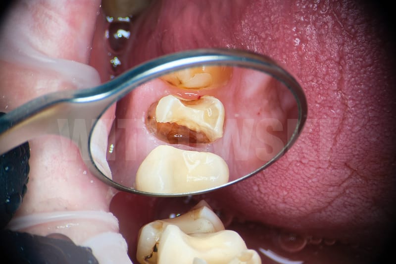 Leczenie powtórne d.24