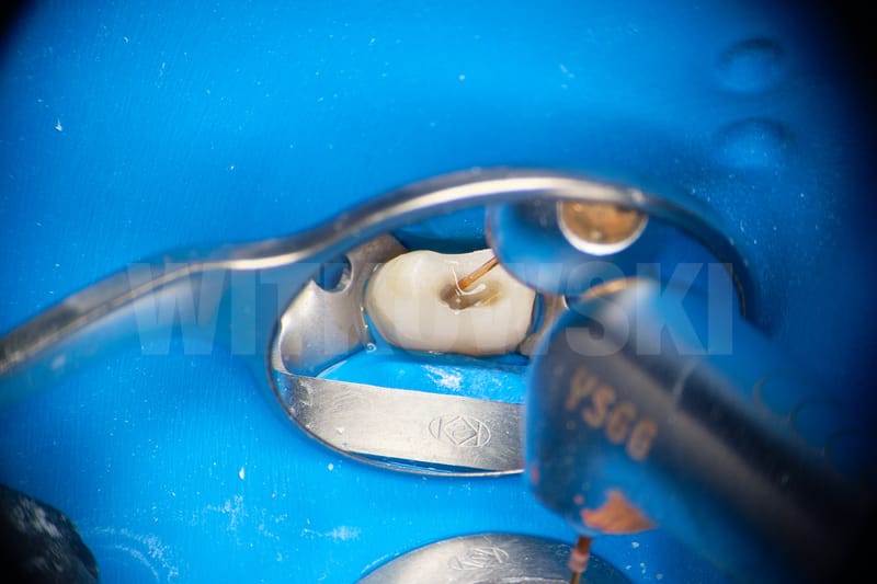 Leczenie powtórne d.24