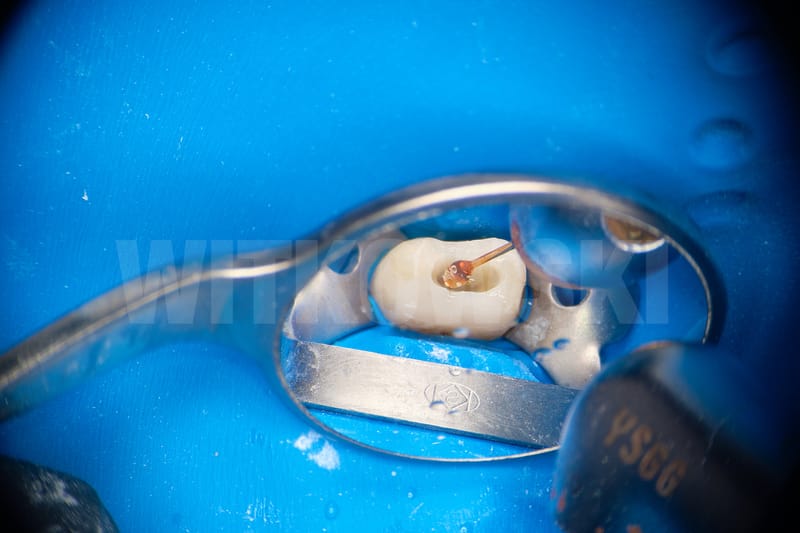 Leczenie powtórne d.24