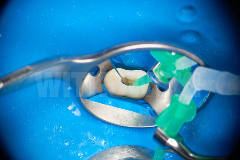 Leczenie powtórne d.24