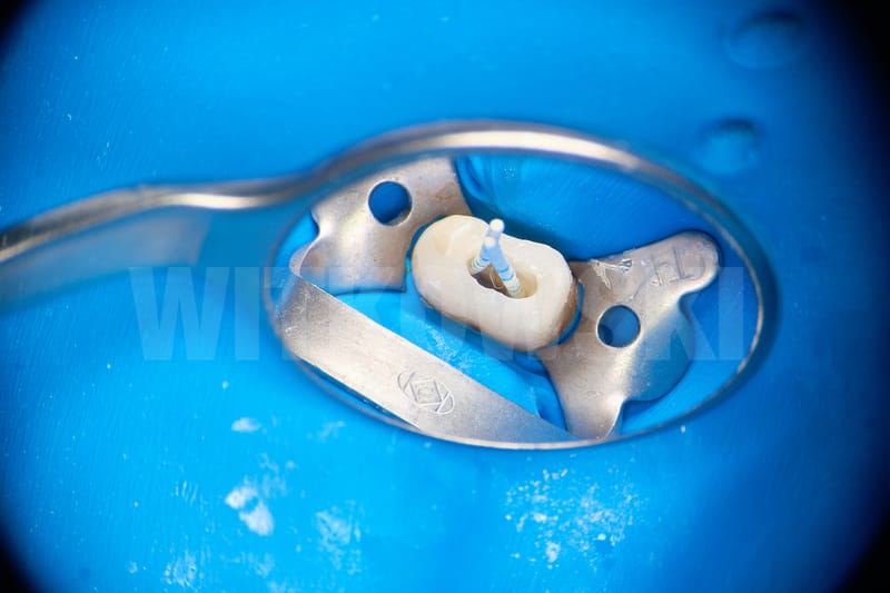 Leczenie powtórne d.24