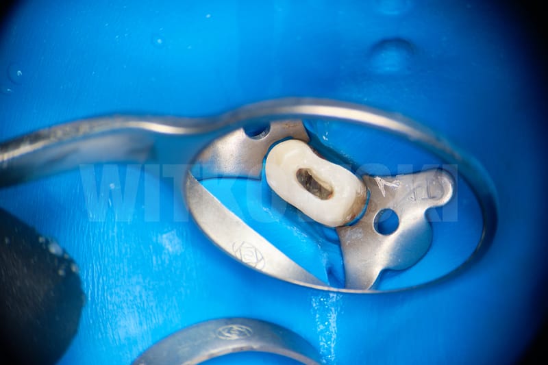 Leczenie powtórne d.24