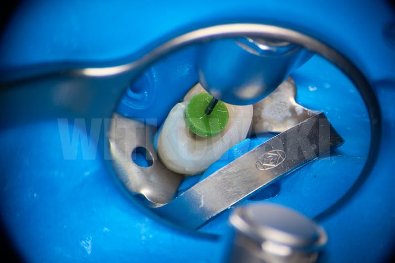 Leczenie pierwotne d.24