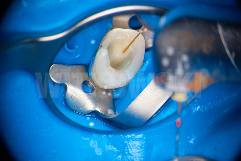 Leczenie pierwotne d.24