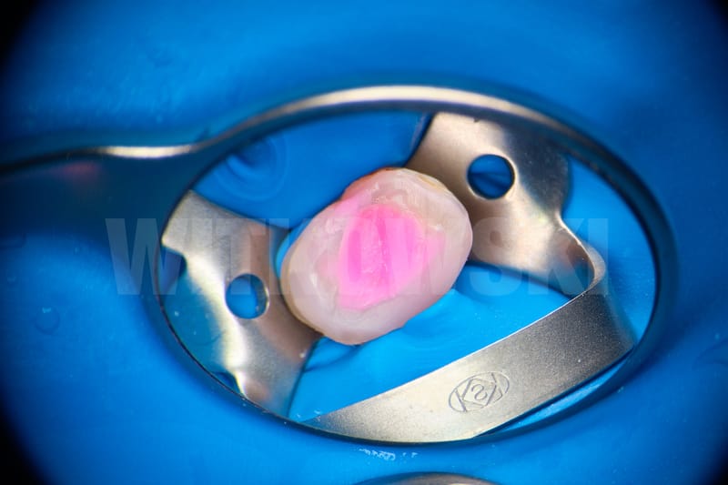 Leczenie pierwotne d.24