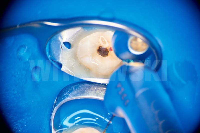 Leczenie pierwotne d.18