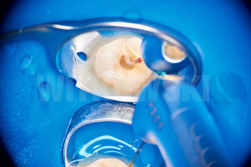 Leczenie pierwotne d.18