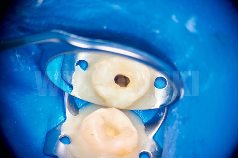 Leczenie pierwotne d.18