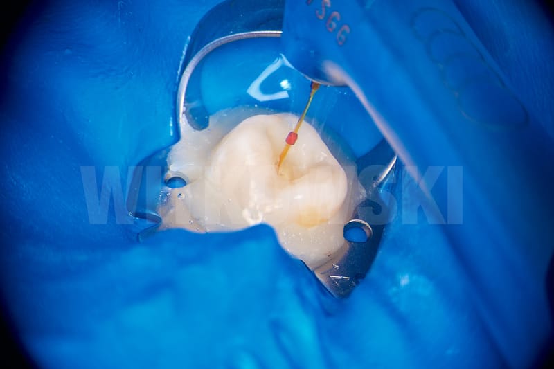 Leczenie pierwotne d.18