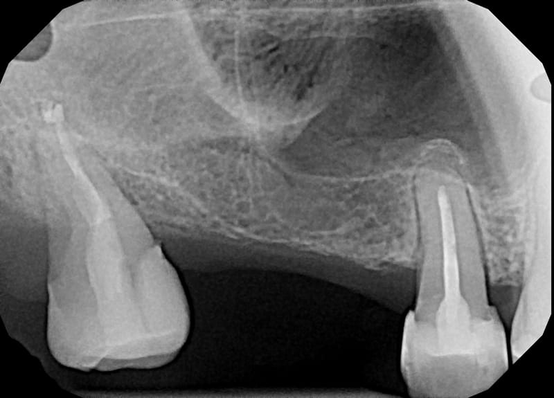 Leczenie pierwotne d.18