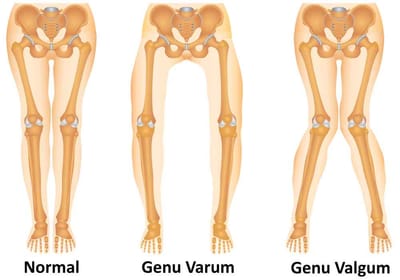 Différents types de pathologies  les plus fréquentes  du genou causées par le déséquilibre du pied.