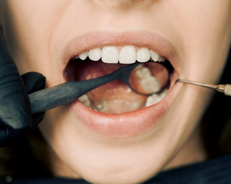 Dental Insurance