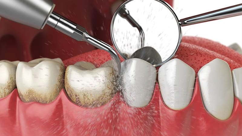 LIMPIEZA DENTAL PROFUNDA