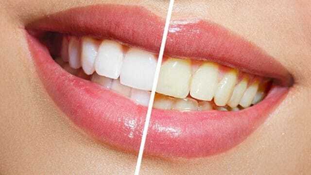BLANQUEAMIENTO DENTAL
