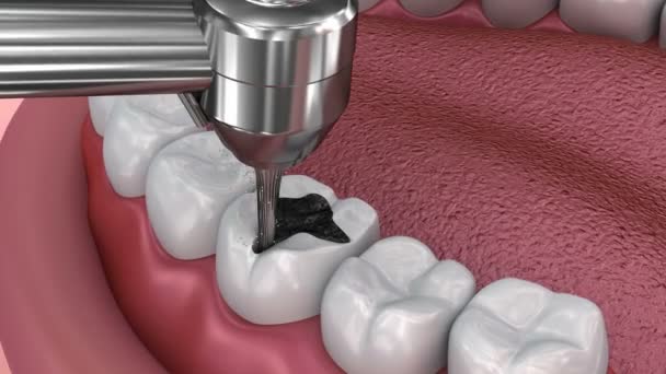 RESTAURACIONES DENTALES