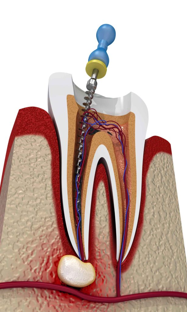 ENDODONCIA
