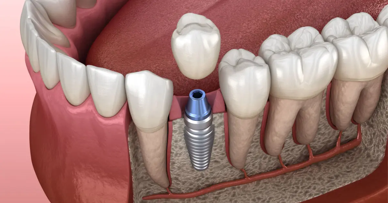 IMPLANTES