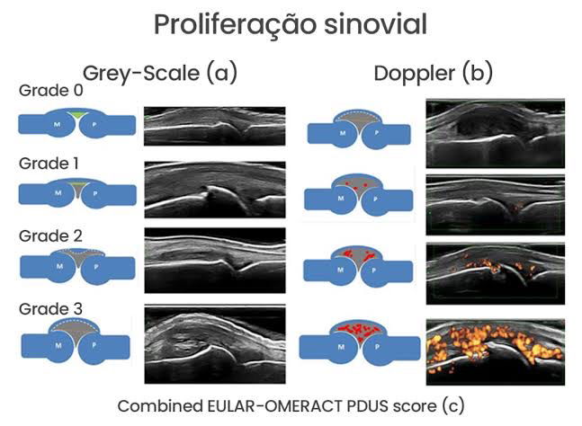 Ultrassom reumatológico: por que e como solicitar.