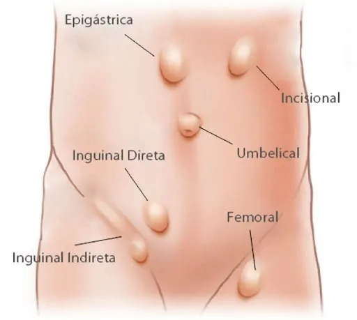 HÉRNIA DE PAREDE ABDOMIAL: qual ULTRASSOM devo solicitar?