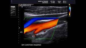 DOPPLER DE ARTÉRIAS CARÓTIAS E VERTEBRAIS